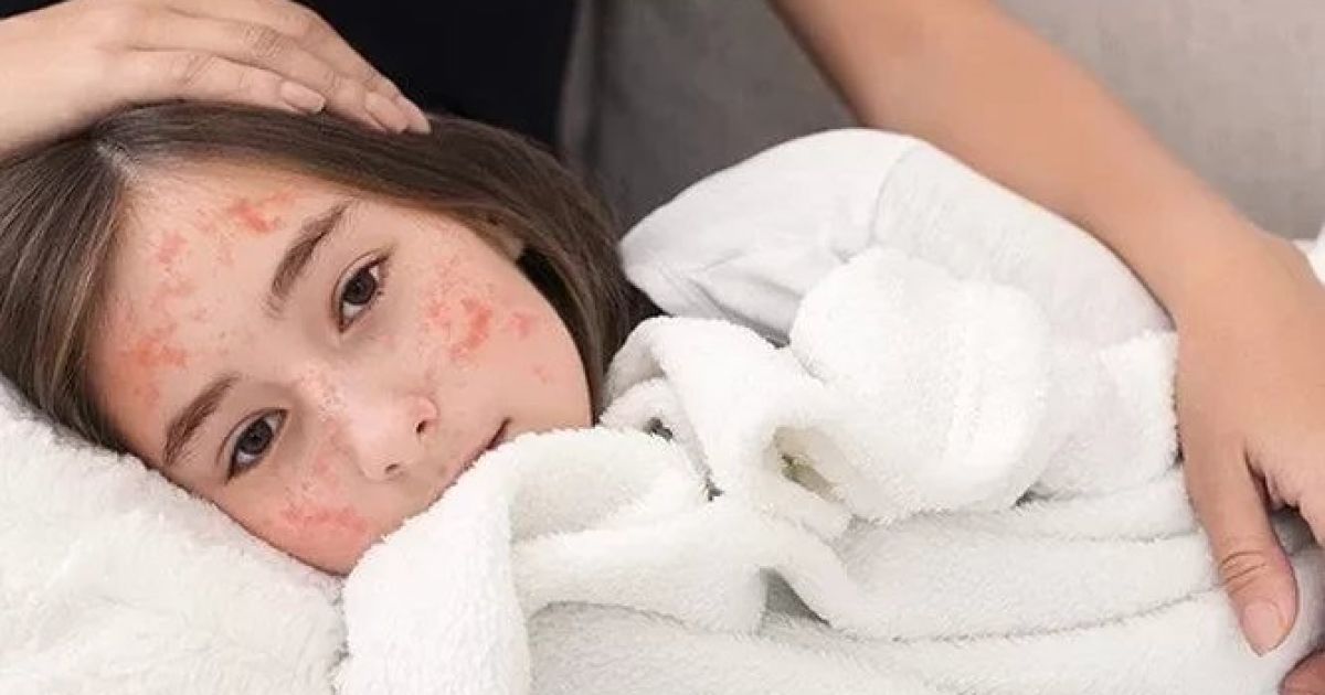 Ilustrasi Campak (Pixabay)